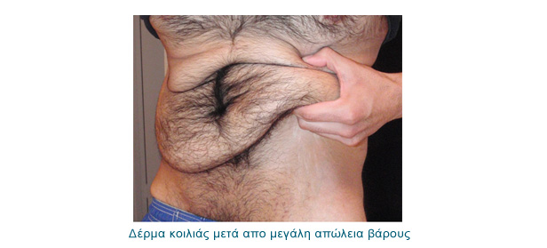 Πλαστική μετά από πολύ μεγάλη απώλεια βάρους