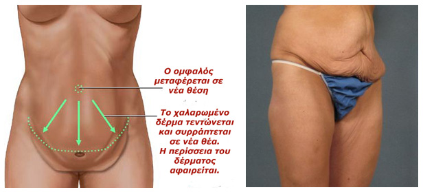 Πλαστική μετά από πολύ μεγάλη απώλεια βάρους