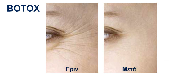 BOTOX ΠΡΙΝ ΜΕΤΑ