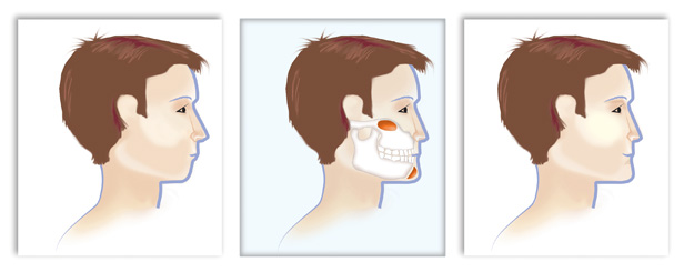 Βελτίωση σχήματος προσώπου