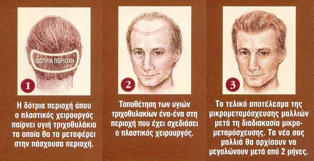 Μεταμόσχευση μαλλιών