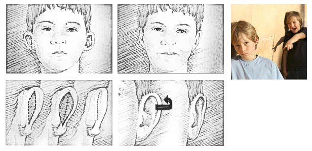 Ωτοπλαστική