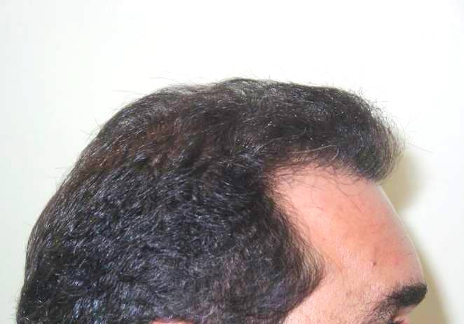 metamosxeusi-malliwn-meta