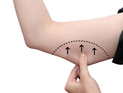 Βραχιονοπλαστική