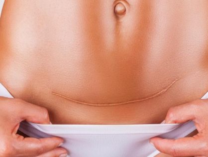 Διόρθωση ουλών