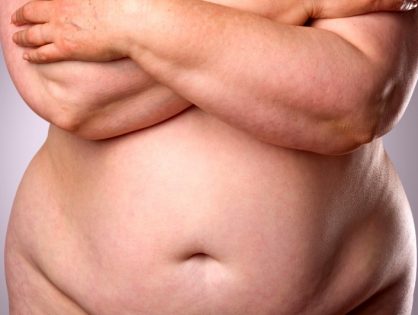 Πλαστική μετά από πολύ μεγάλη απώλεια βάρους